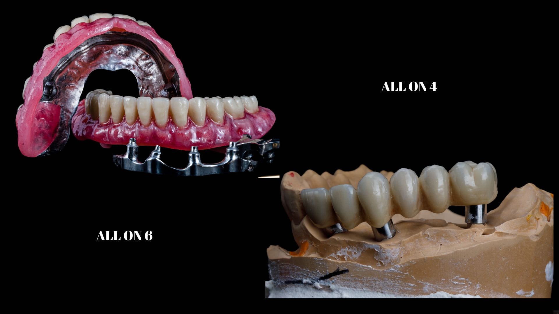 Dantura completă. Cât costă implanturi dentare pentru toată gura? 1 All on 4 si all on 6