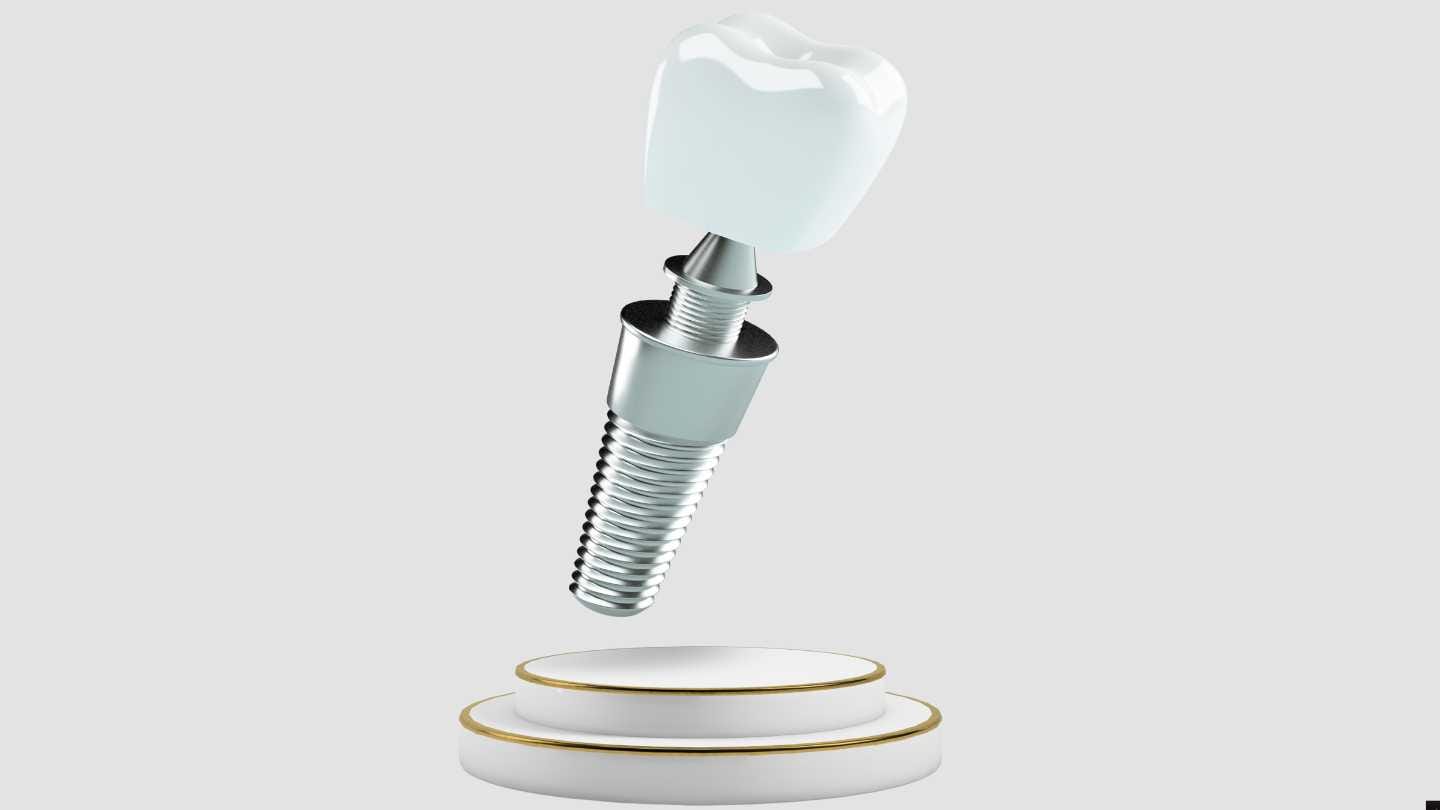 Respingere Implant Dentar: Factori, Simptome și Soluții Clinice 3 implant dentar 4
