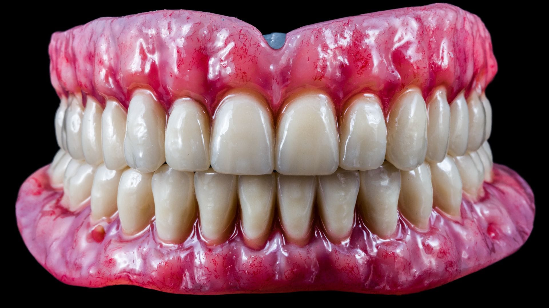 Dantura completă. Cât costă implanturi dentare pentru toată gura? 2 rezultat