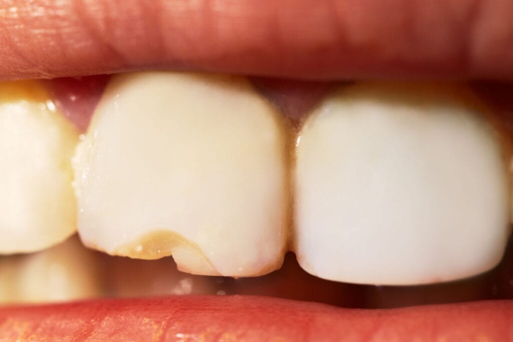 dinte spat tramanet fatete dentare